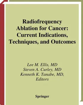 Radiofrequency Ablation for Cancer