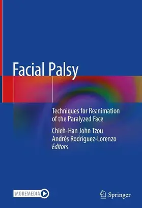 Facial Palsy