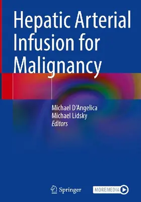 Hepatic Arterial Infusion for Malignancy