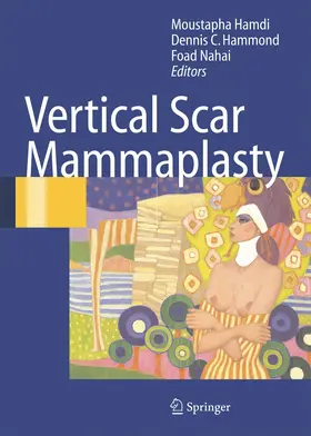 Vertical Scar Mammaplasty