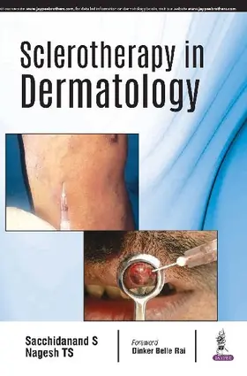 Sclerotherapy in Dermatology